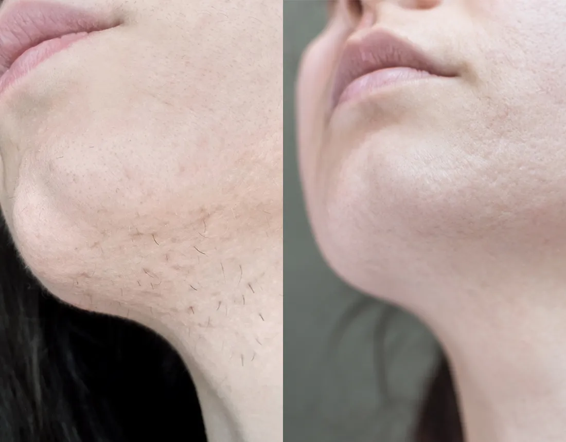 Eflornithine results 2