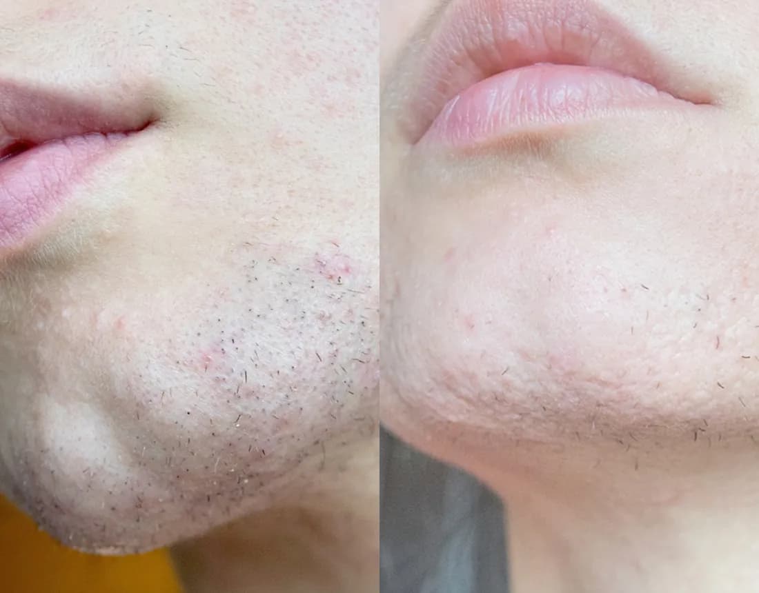 Eflornithine results 3