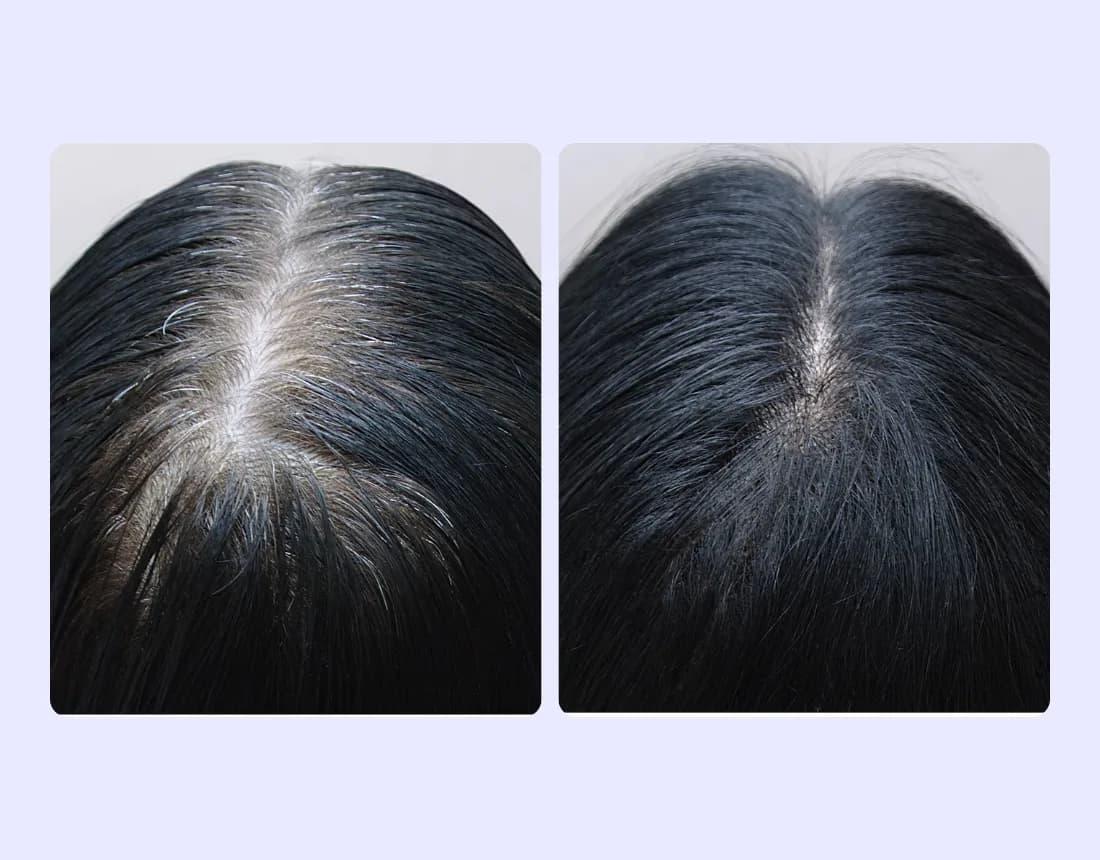 Oral Minoxidil Product 1