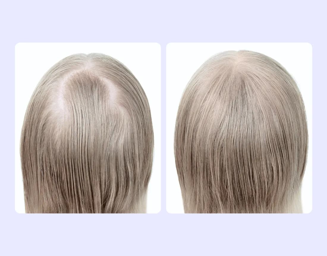 Oral Minoxidil Product 2
