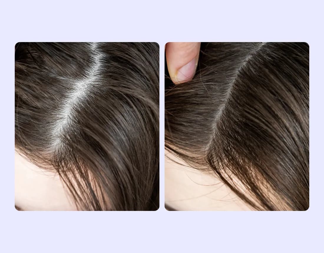 Oral Minoxidil Product 3